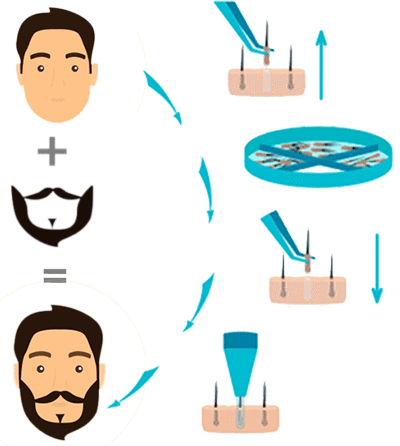 مراحل کاشت ریش و سبیل